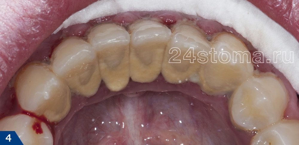 Твердые зубные отложения на внутренней поверхности нижних зубов