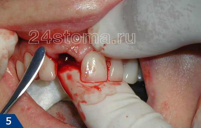 Кровотечение после лечения зуба thumbnail