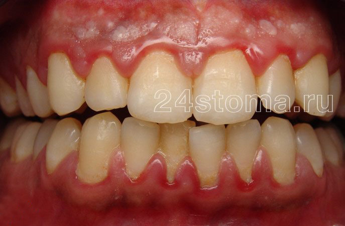 Скопления мягкого микробного зубного налета в области шеек зубов (имеются симптомы воспаления десен - гингивита)