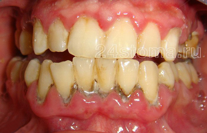 Твердые над и поддесневые зубные отложения в области нижних зубов (имеются симптовы воспаления десен - пародонтита, включая гнойное отделяемое из пародонтальных карманов)