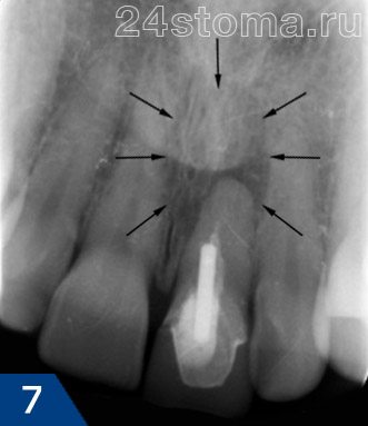 Рентгенограмма центрального резца:  в области верхушки корня отмечается киста размерами более 1 см (ограничена черными стрелками)