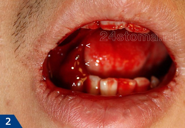 Обильные сгустки крови после удаления нижнего зуба
