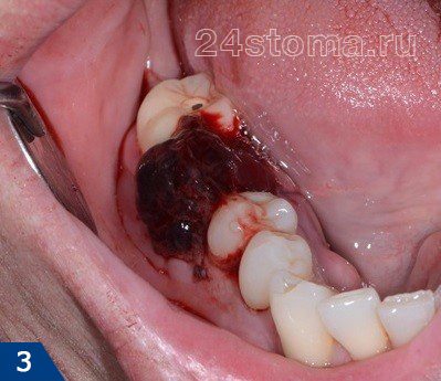 Обильные сгустки крови после удаления нижнего 6-го зуба