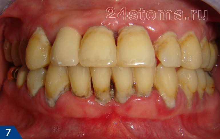 Хронический пародонтит (скопления мягкого микробного налета, над и поддесневыз зубных отложений, атрофия десны. )