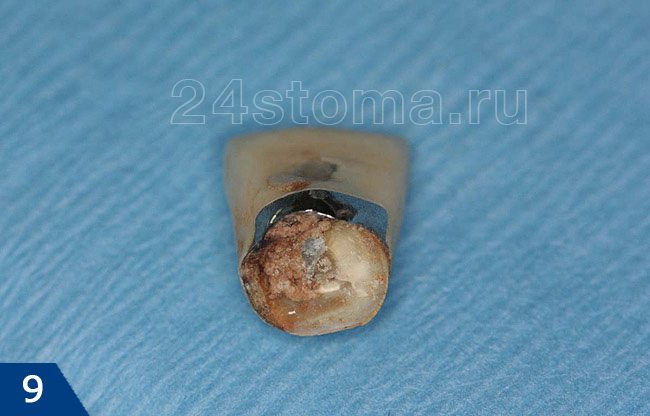 Выпавшая (в результате гниения тканей зуба) искусственная коронка