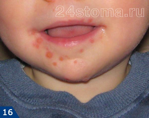 Герпетические высыпания на красной кайме губ и коже лица