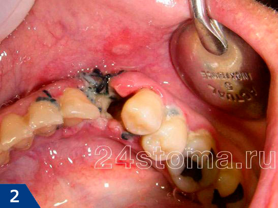 Воспаление лунки удаленного зуба