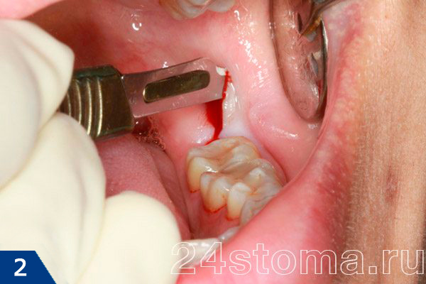 Отек после удаления зуба: причины и лечение