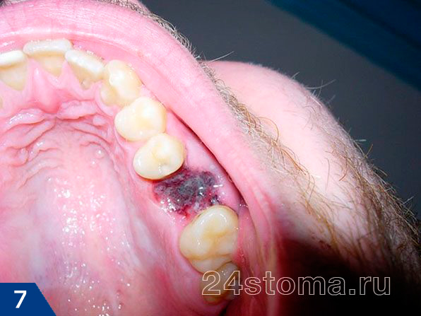 Вид кровяного сгустка в лунке удаленного зуба через несколько дней после удаления (поверхность сгустка покрыта белесоватым фибринозным налетом, это норма)