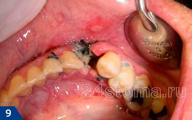 Альвеолит лунки удаленного зуба