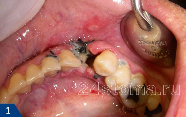 Альвеолит после удаления зуба: фото, лечение, сухая лунка