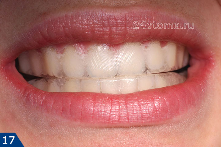Вид отбеливающей полоски, фиксированной на зубах