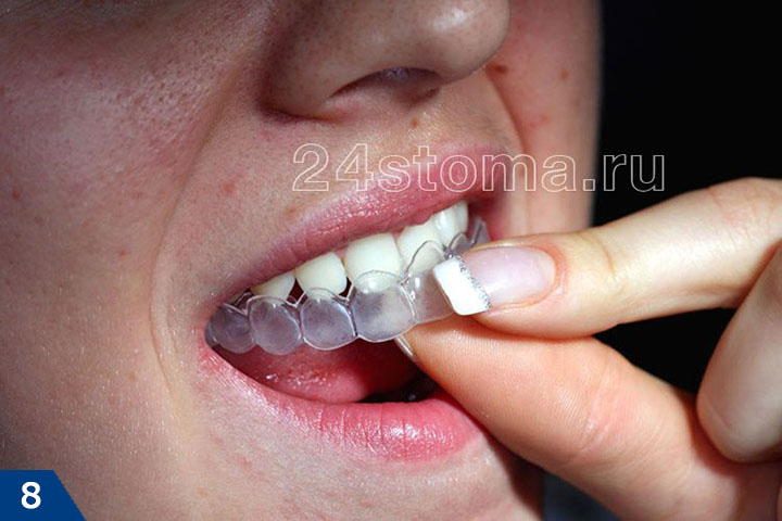 Пациент надевает индивидуальную каппу на верхние зубы