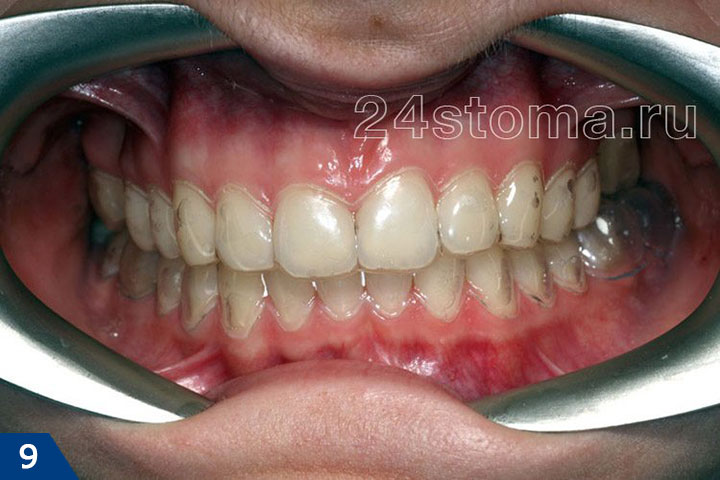 Вид зубов верхней и нижней челюсти с надетыми индивидувльными зубными каппами
