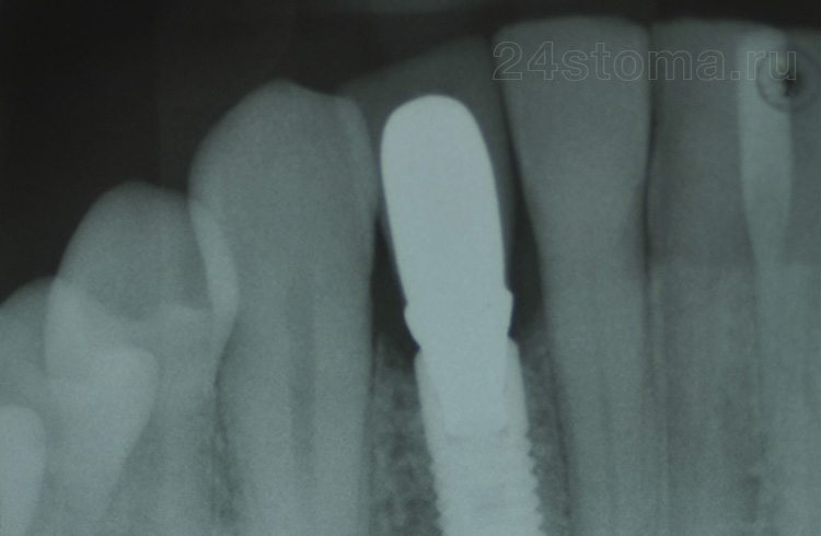 Вид этого импланта с коронкой на рентгенограмме