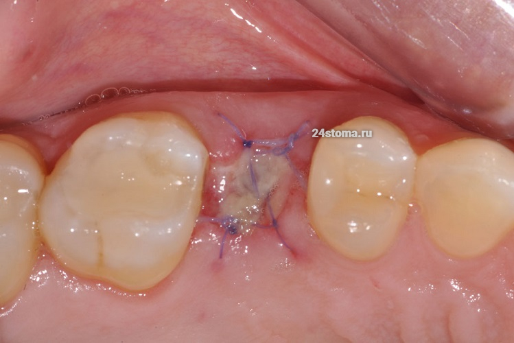 Вид лунки всего через 3 дня после удаления зуба