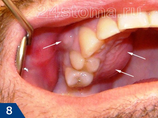 Двухстронний абсцесс (флюс) со стороны неба и щеки, появившийся из-за некачественного лечения зуба