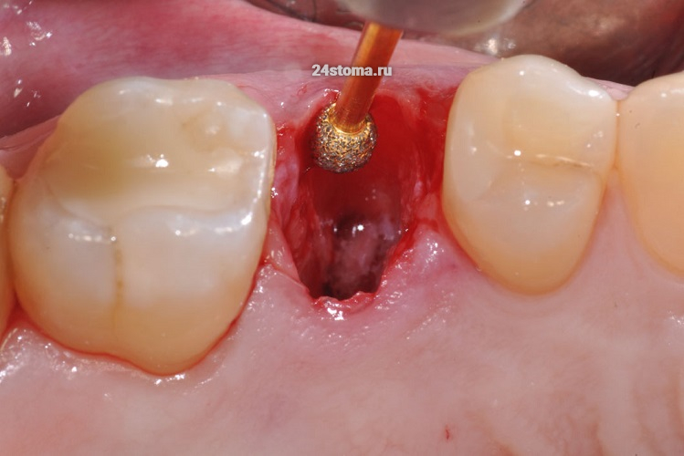 После удаления зуба из лунки вычищают грануляции + проводится частичная деэпителизация десневого края