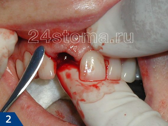 Сколько стоит удаление зуба или лечение thumbnail
