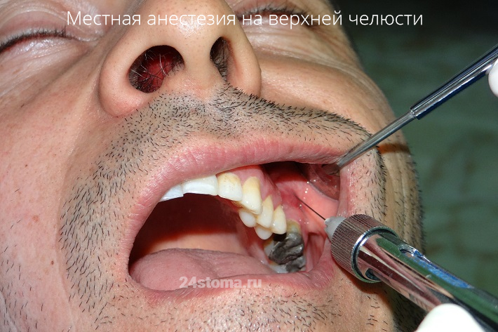 Местная анестезия в стоматологии (обезболивание 6 моляра на верхней челюсти)