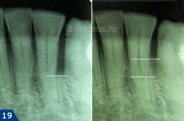 Рентгеноские снимки уровня костной ткани до и спусти несколько месяцев поле операции (прирост костной ткани достигает около 2,5 мм)