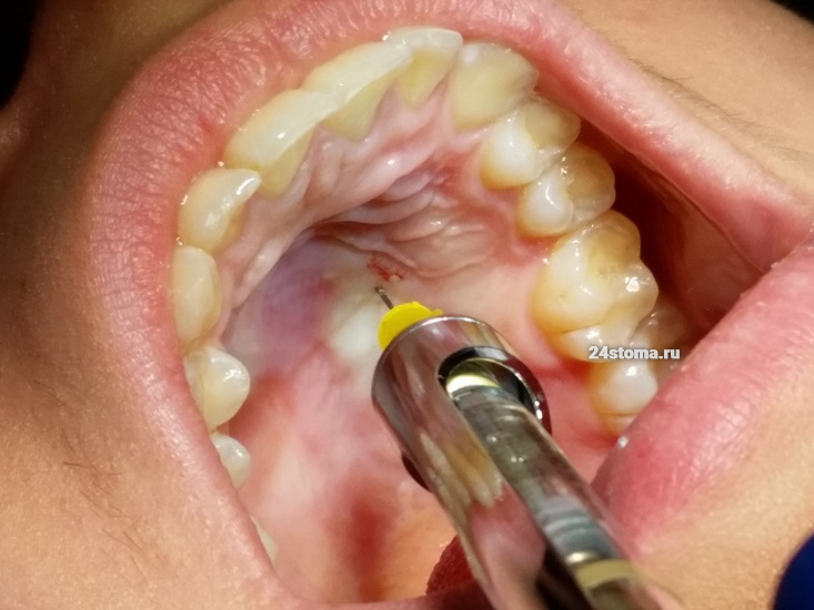 Небная анестезия в стоматологии