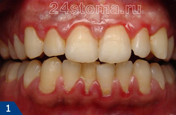 Слабые отечные десны при гингивите (в пришеечных областях скопления зубного налета, зубодесневые сосочки красные, отечные, легко кровоточащие)