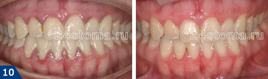Состояние десен до и после снятия зубных отложений ультразвуком