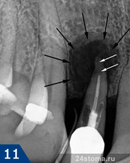 Рентгенограмма воспаления у верхушки корня зуба (ограничено черными стрелками), возникшего в результате недопломбировки корневого канала (недопломбированная чать указана белыми стрелками)