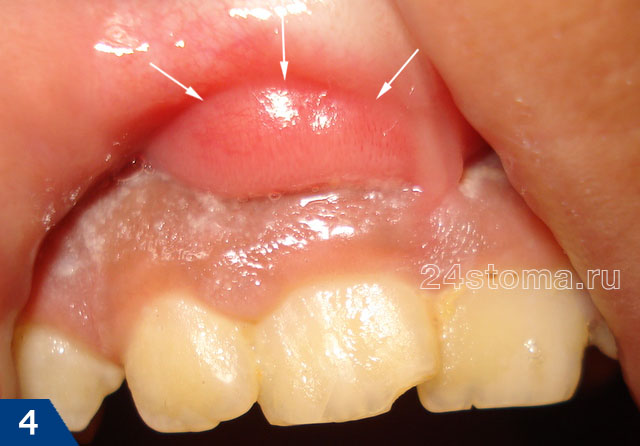 Гнойник на десне (флюс) в области резцов верхней челюсти. Причинный зуб имеет разрушение коронки.