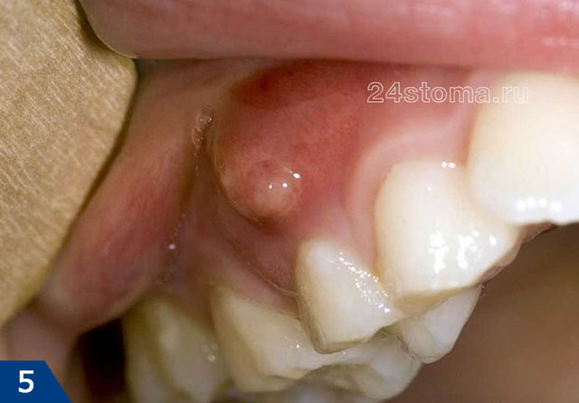 Гнойник на десне над зубом (причинный зуб имеет глубокую кариозную полость в межзубном промежутке)