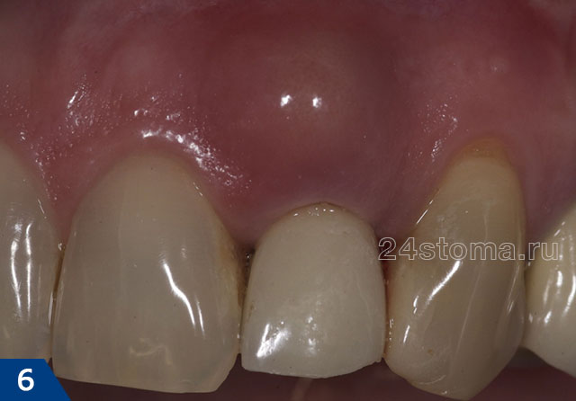 Гной в десне над зубом (гнойный абсцесс образовался по причине плохого пломбирования корневого канала, коронковая часть зуба полнотью восстановлена из пломбировочного материала)