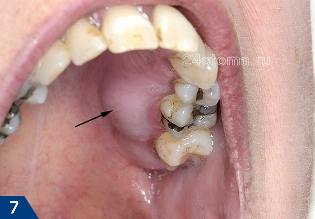 Гнойный абсцесс со стороны неба в проекции 6 зуба (зуб имеет старые пломбы из амальгамы, периодонтит развился вследствие кариеса под пломбой) 