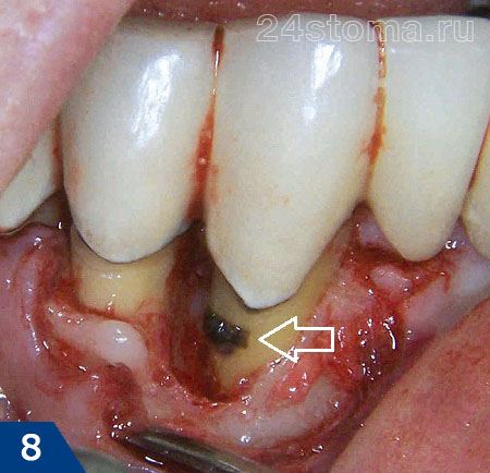 После хирургической отслойки десны визуализирован пародонтальный карман, и расположенный на поверхности корня зуба - твердый зубной камень.
