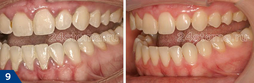 Состояние десен до и после снятия зубных отложений ультразвуком