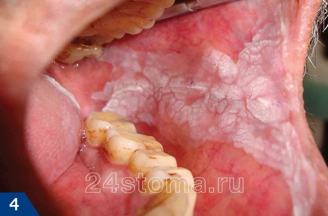 Лейкоплакия слизистой щеки и угла рта