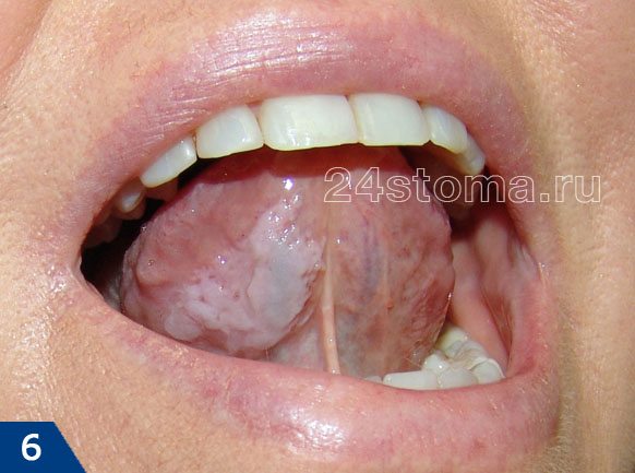 Лейкоплакия, локализованная на нижней поверхности языка