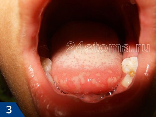 Герпетический стоматит: герпетические высыпания на кончике языка