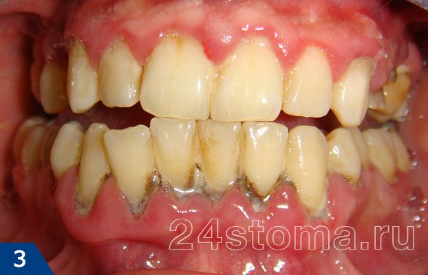 Хронический пародонтит ( массивные скопления мягких и твердых зубных отложений, обнажение шеек зубов, отек и покраснение десны...)
