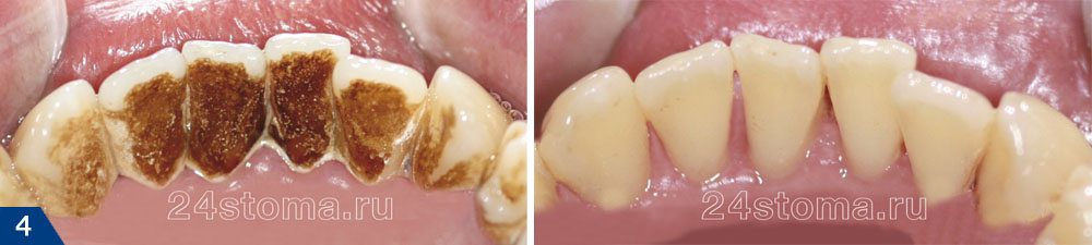 Удаление зубного налета (фото до и после)