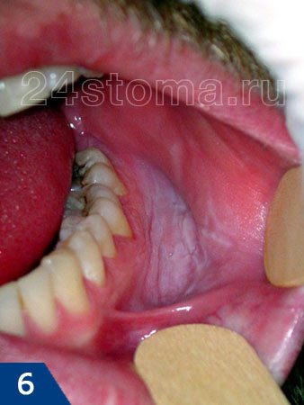 Лейкоплакия слизистой оболочки полости рта (в виде белого пятна)