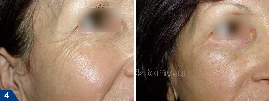 Коррекция морщин в уголках глаз (фото до и после)