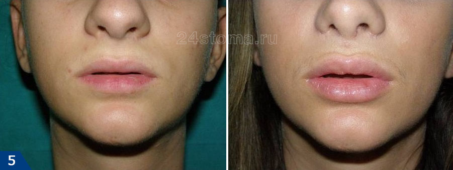 Увеличение объема губ (фото до и после)
