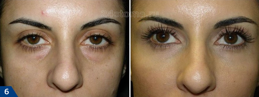 Увеличение объема мягких тканей с целью убрать мешки под глазами (фото до и после)