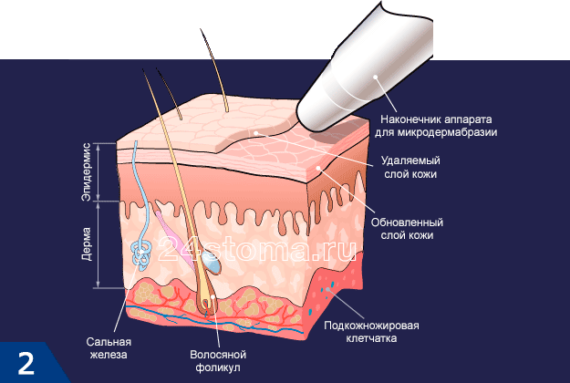 Микродермабразия (схема удаляемого слоя кожи)