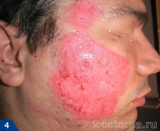 Вид кожи после дермабразии правой половины лица