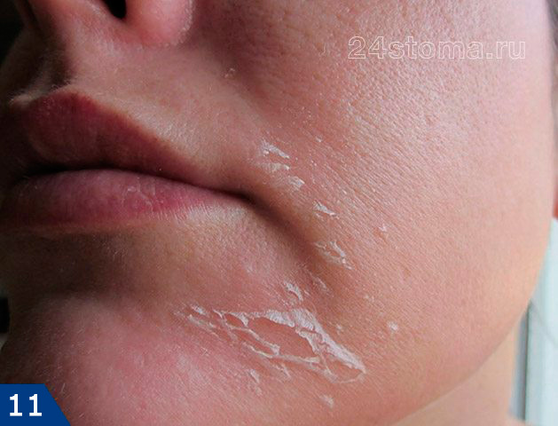 Шелушение кожи в начале применения Ретин-А