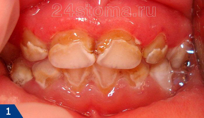 Множественный кариес зубов у ребенка. Отек и покраснение краевой десны (гингивит).
