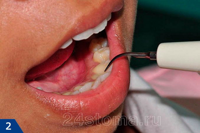 Удаление зубных отложений ультразвуковым наконечником