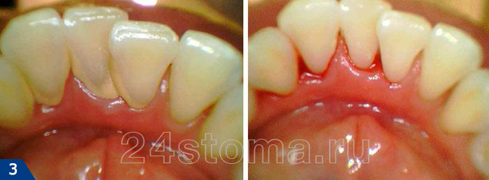 Удаление зубных отложений с язычной поверхности нижних резцов: До и После